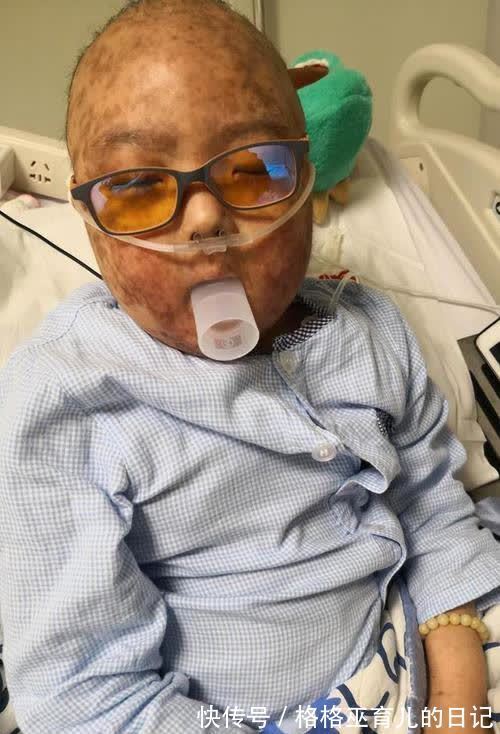 母亲|6岁男童身患白血病,长出“蛇皮”,生前说出的这18个字让母亲痛哭
