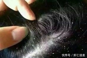 太阳穴|头发若有这四种表现,意味着你的肝脏可能在“中毒”,别不当回事