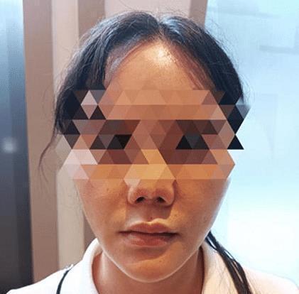 女子 女子整形感染后变“朝天鼻”，此前曾做过5次手术