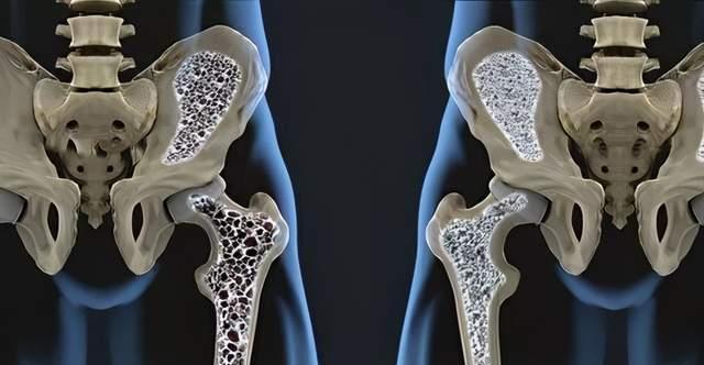 中年|到了50歲以上，不想骨質疏松多吃1種“零食”，補鈣關節都不疼了