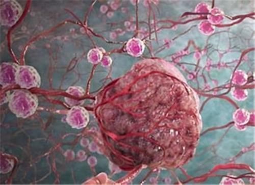 肿瘤细胞|肿瘤一般治不好,能治好的都是误诊了?肿瘤医生说出了心里话