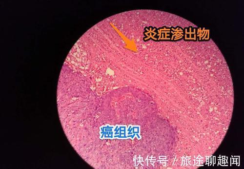 发酵|多吃发酵食品,能减少体内炎症?医生:这6类食物可多吃