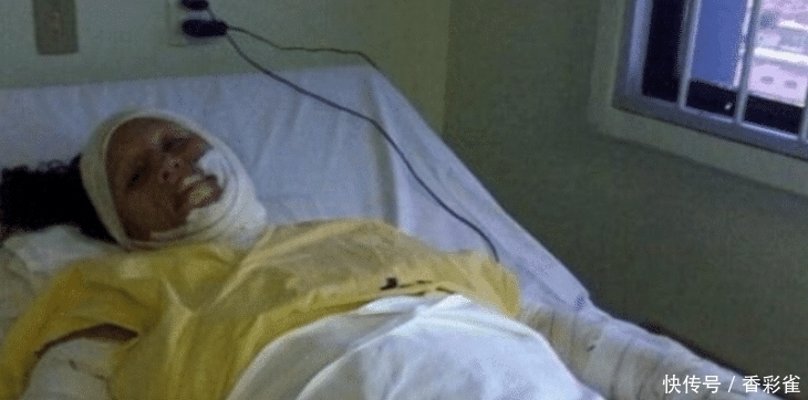 痊愈|女子全身被烧伤,医生植入“鱼皮”痊愈,网友:能美白吗?