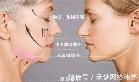 蛋白线|看完这个,你还敢做线雕隆鼻吗?