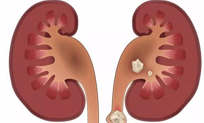 钙片|骨质疏松，钙片什么时候吃最好？会不会致肾结石？