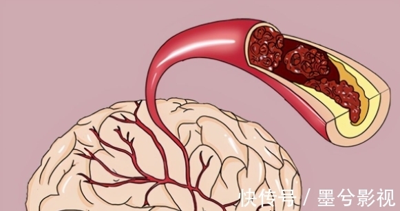 超标|28岁男子脑梗离世,医生提醒:1物是血脂“升高剂”,怎能天天吃
