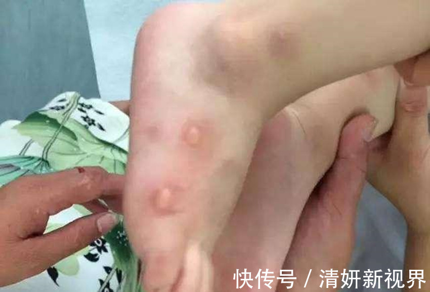 称赞|两岁女儿不小心被开水烫伤,孩子爸的做法令医生称赞简单又专业