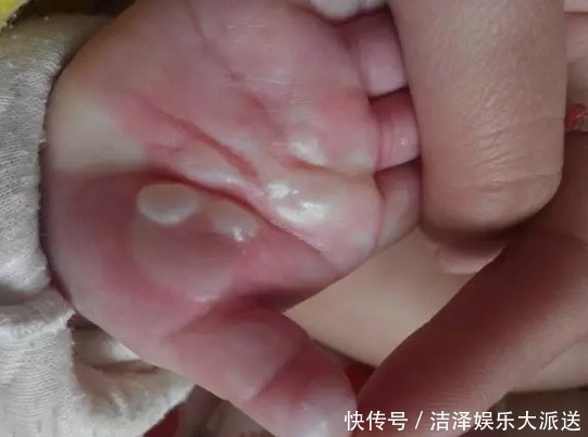 伤情|孩子被烫伤后该先冲水还是先脱衣服这一步错了,可能伤情会更重