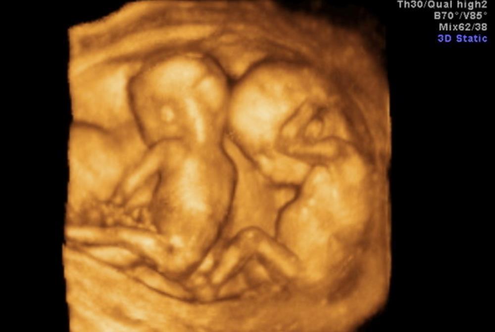 玲珑|做四维彩超后,不做这步相当于“白花钱”,在检查前孕妈要问明白