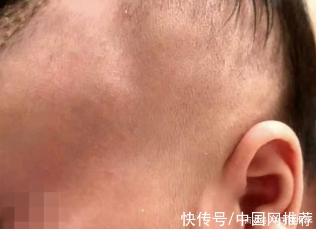 宝宝|痛心!因月嫂打瞌睡，出生6天的宝宝被摔成颅骨骨折