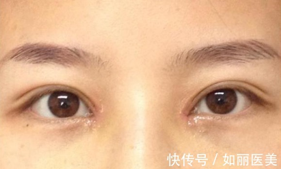 经验 做过全切双眼皮手术的"过来人",分享10条最实用的经验