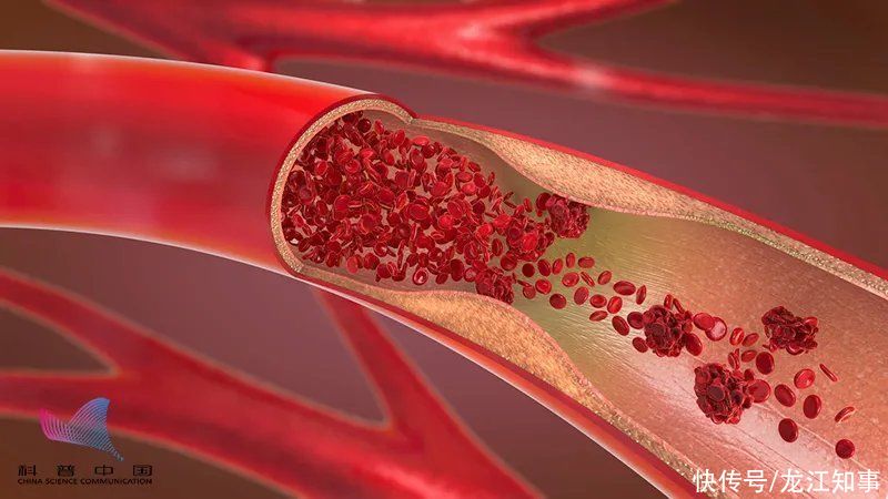 糖尿病|血压、血糖、血脂数值越低越好?危险!出现这些情况死亡风险易增加