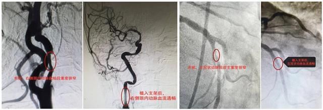 王万铭|七旬老人脑梗心梗叠加 心脑专科医生联手开通“血管隧道”