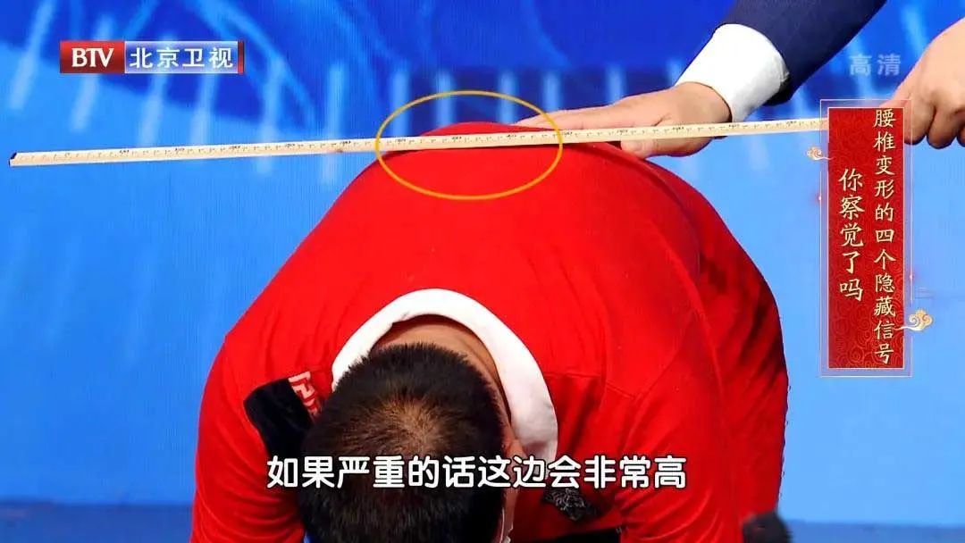 椎间盘|腰椎变形不自知？4个危险信号，1个锻炼方法，快速识别、提前预防~