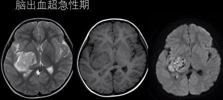 大脑血管疾病|5大脑血管疾病的MRI表现，一文总结