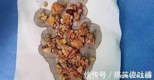 孩子|5个月婴儿肾结石，医生全是辅食惹的祸，许多家长还在这么喂