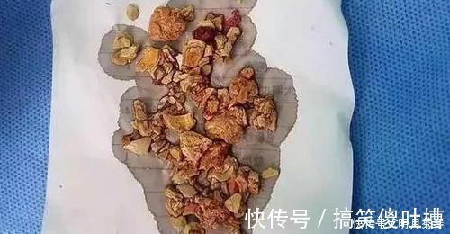 孩子|5个月婴儿肾结石,医生全是辅食惹的祸,许多家长还在这么喂