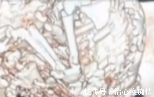 婴儿|“婴儿”在肚子里一住就是61年!妈妈91岁了才被发现,伤心欲绝