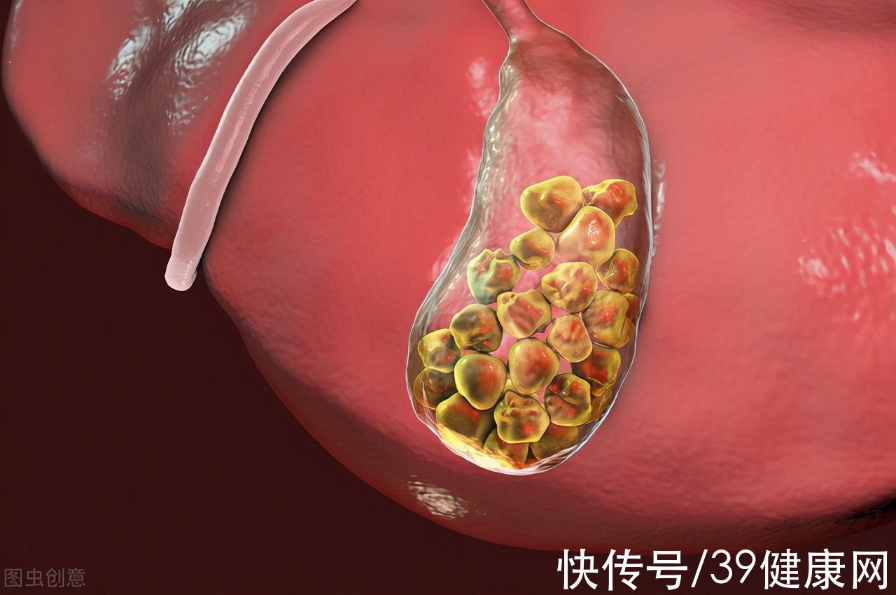 胆漏|胆囊切除有啥后遗症？这3种“结果”不好受，医生不一定告诉你