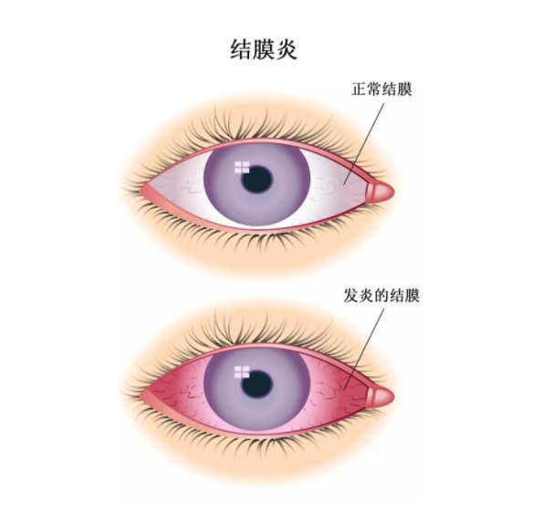 后遗症|新冠后遗症：闻不到味道事小，还有结膜炎到眩晕，甚至失明失聪