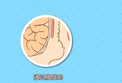 疝囊|疝气不善，家有老人的要注意了