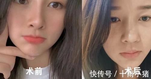 整形手术|女子花了4万做整容,鼻子却留下一个坑?美容院:术前已告知风险