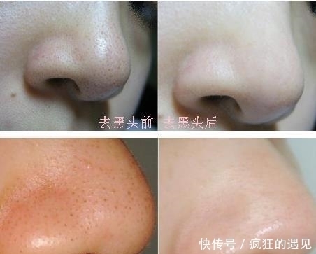 鼻子上黑头多怎么办，这样做让你告别“草莓鼻”