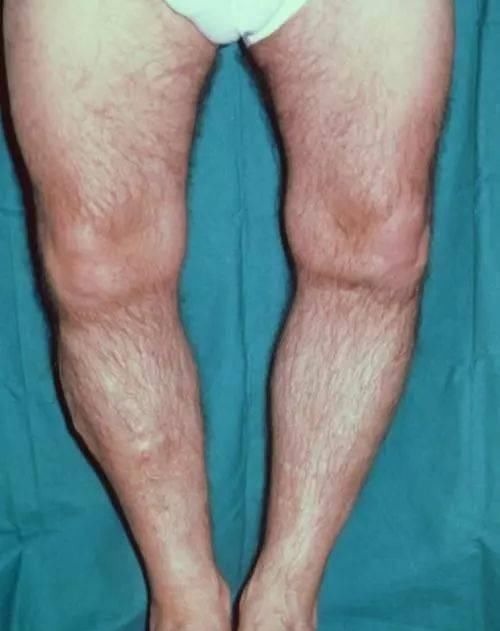 肾衰|9岁男孩排不出尿,查出肾衰,医生说孩子这几处不能随便打