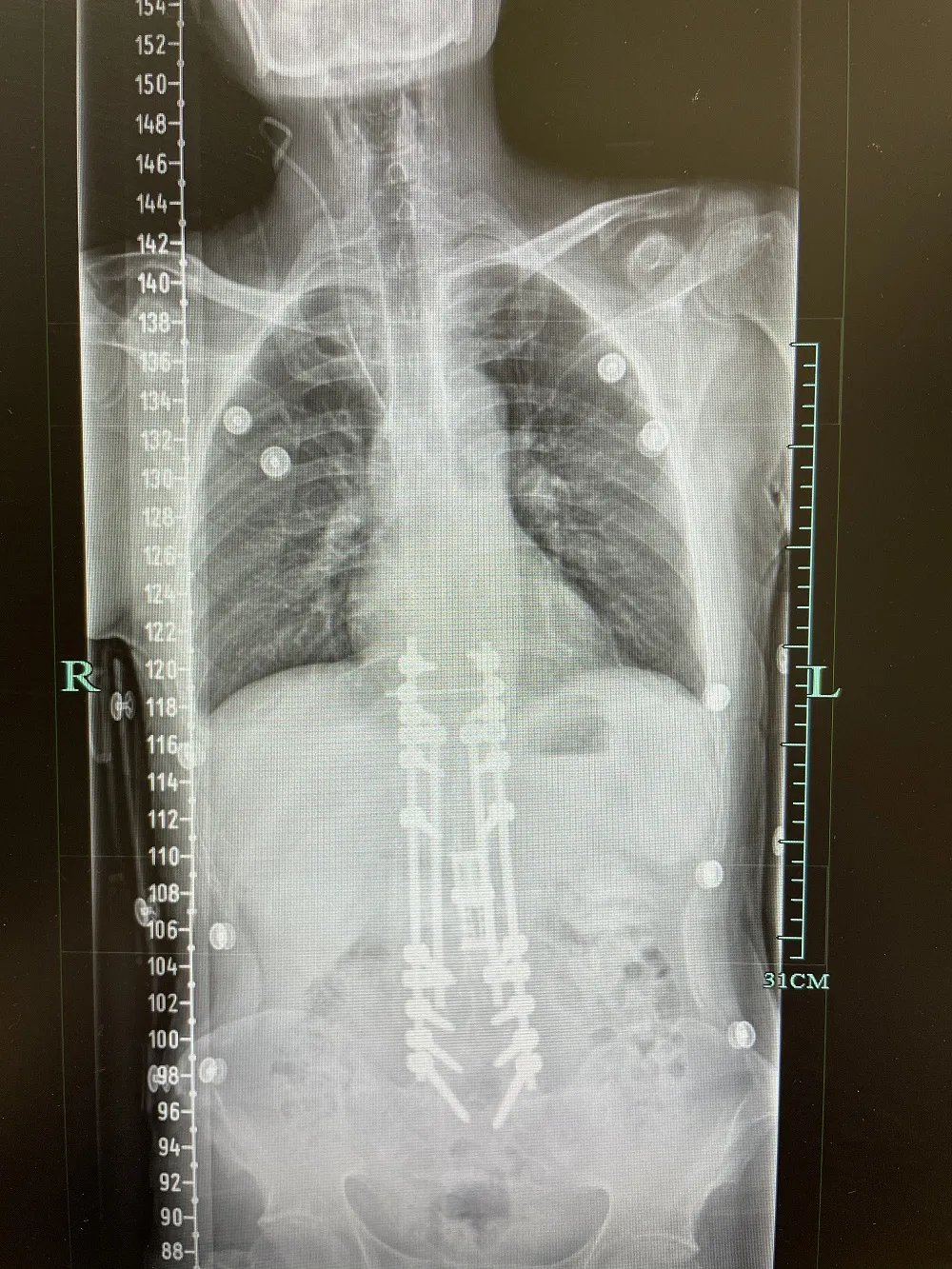 副主任|35岁安徽小伙腰痛驼背鼓起一个包，医生完成高难度手术让他重新挺直脊梁