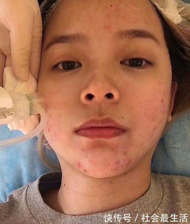 恢复步骤 必看,正确的水光针术后恢复步骤!必看,正确的水光针术后恢复步骤!