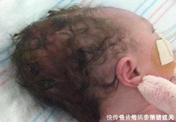 颅骨|德国妈妈坚持顺产不想留疤,宝宝出生后颅骨骨折5天后夭折