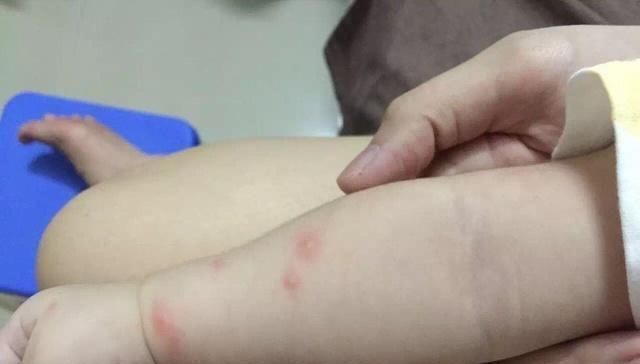 吸引力|你的孩子是吸引的蚊子“磁铁”吗他经常被咬的5个原因