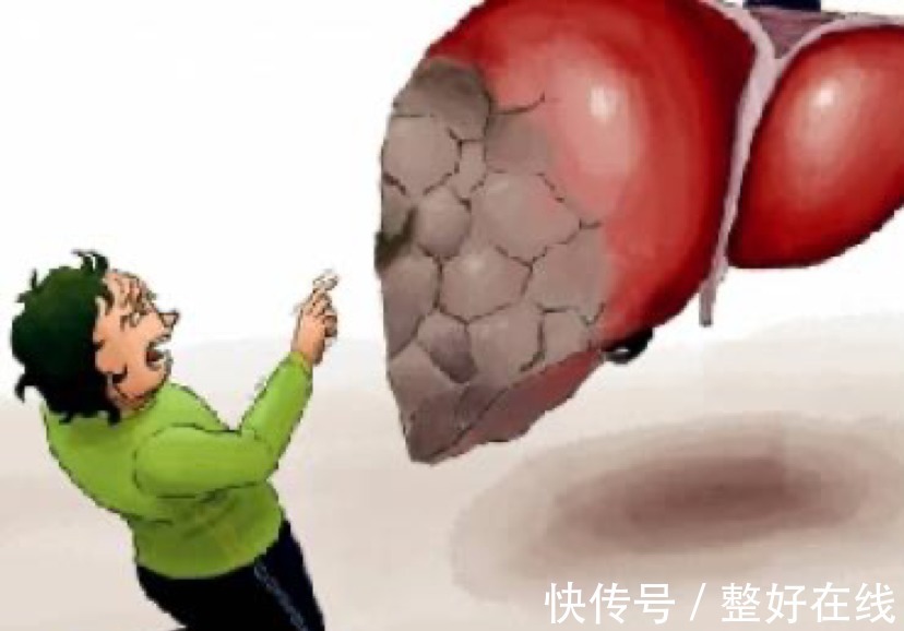 肝硬化患者|提醒:肝硬化早期不痛不痒!一旦发现这4症状,多半是肝硬化来了
