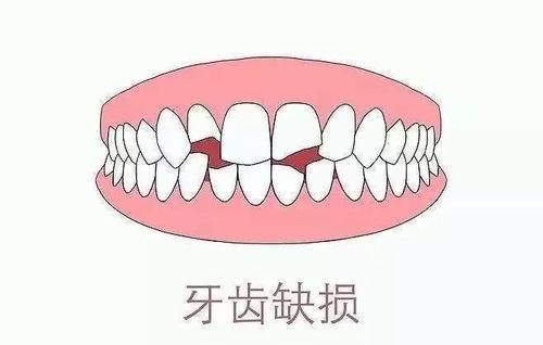  吃东西塞牙缝？专家：小心牙周炎