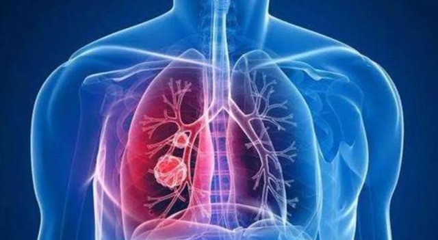 水果|肺结节能预防吗医生建议尽量多吃这3种水果，肺或感激你