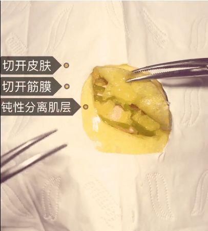手术|给火龙果割阑尾33岁水果医生爆红吸粉90万网友看到第一个就痛了