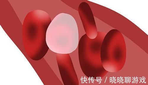血管|斑块多，血管堵，如何清理血管，预防堵塞小妙招不妨学一学
