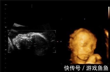 肾盂分离|四维彩超单辨男女,准不准?