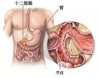 ct|男子腹痛、黄疸，以为结石手术，打开腹腔医生感慨:肿瘤转移了!