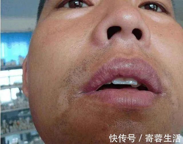 血液粘稠度|血液粘稠的人,身体会有5种表现,若没有,说明血管还算通畅