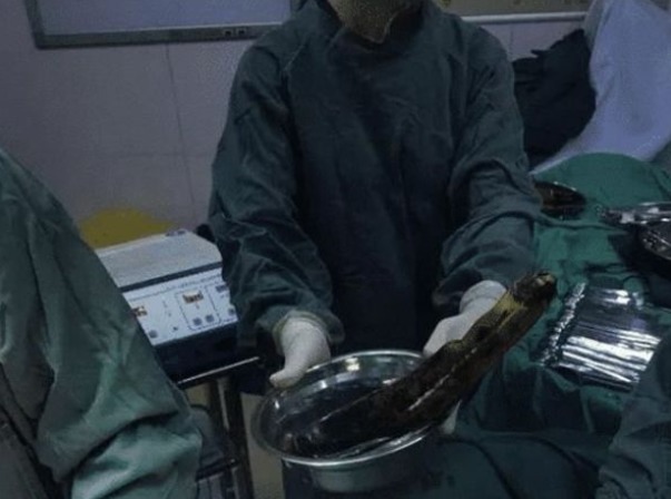 医生|30厘米的黄瓜快顶到心脏了,医生也束手无策,直摇头