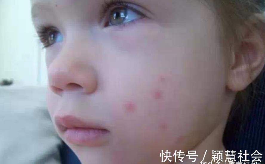 捕蚊|宝宝被蚊子叮咬后，第一步不是帮娃止痒，很多家长都做错了