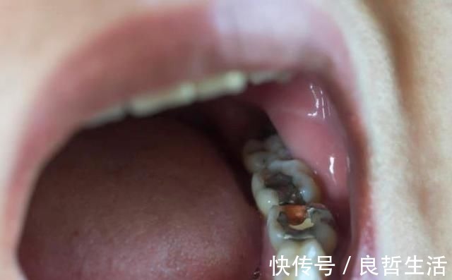 刷牙|10个5岁儿童中,7个有龋齿,罪魁祸首居然不是糖?