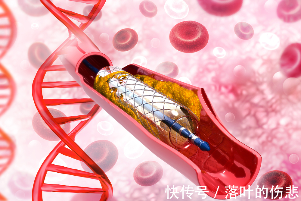 冠脉造影|冠心病拒绝支架,14年后仍健在,医生诧异!原来他只做对了两件事