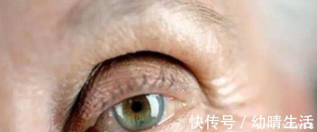 年轻人 做过双眼皮手术的年轻人,老了以后眼睛会怎么样看来是这个道理!