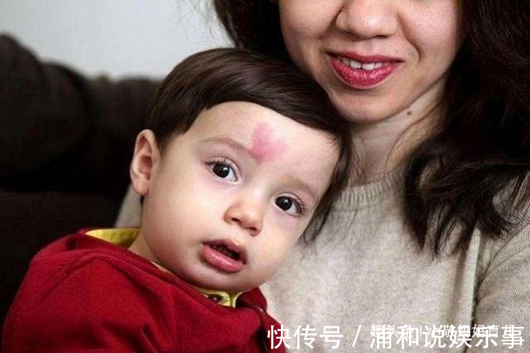 产科医生|胎记是怎么来的?妇科医生:除了遗传,孕期尽量避开这3种行为