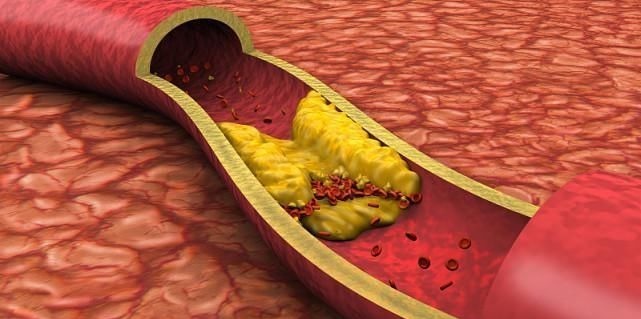 老王|高血脂的人最好不要碰3种食物，多吃一口都是在涨“血脂”，别不当一回事