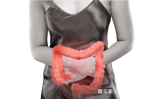 肠镜检查|身体“染上”肠癌，排便会有3个明显异样，这三类人最好定期检查