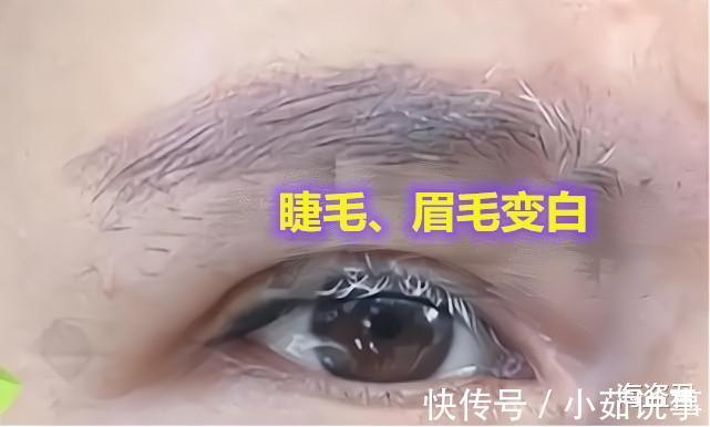 爱美之心 女子割双眼皮后变“白眉大侠”,找美容院讨要说法是手术造成的