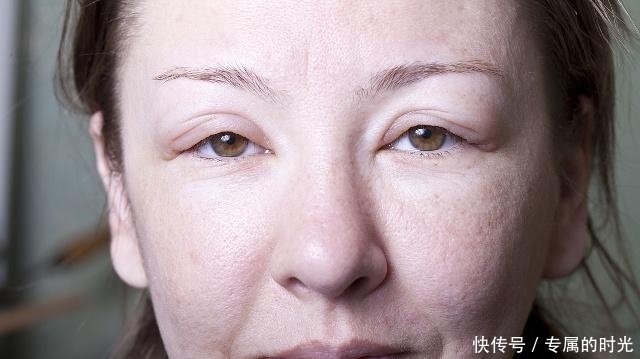  能就会容易|尿酸高的人，身体若有3个“变化”，可能是肾衰竭想“靠近”